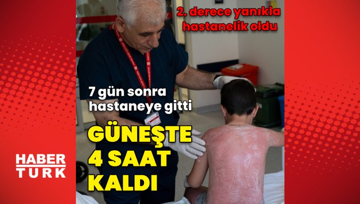 Güneşte 4 saat kalan çocuk, ikinci derece yanıkla hastanelik oldu