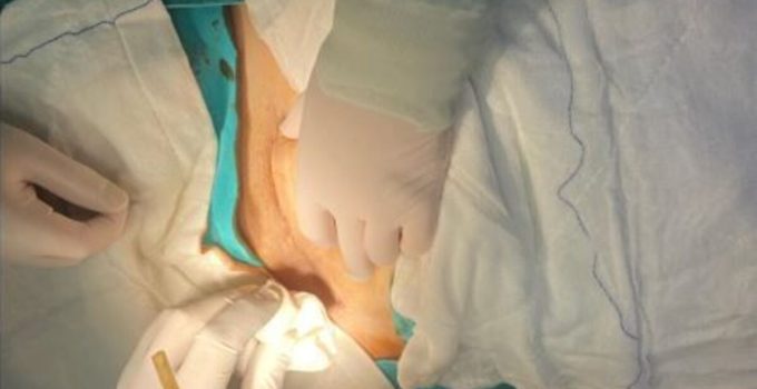 Karnında dren hortumu unutuldu!