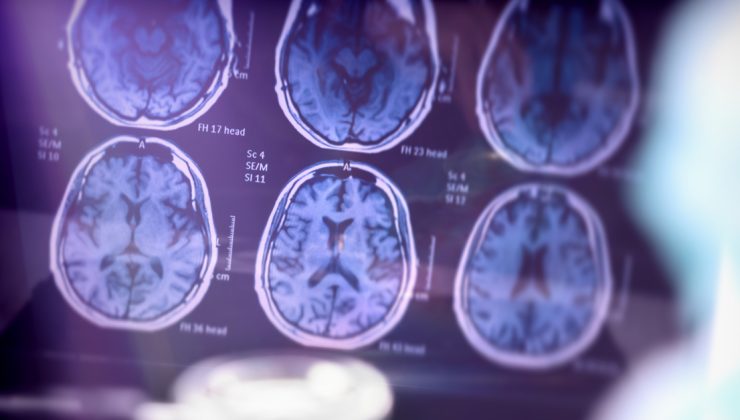 Alzheimer hastaları için “akıllı takip cihazı” desteği 6 ilde başladı