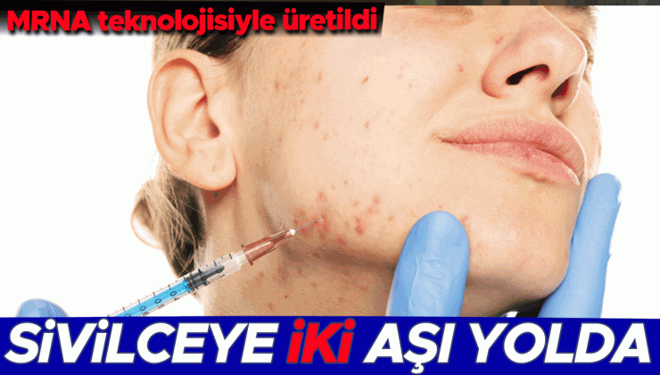 Sivilceye karşı iki aşı yolda