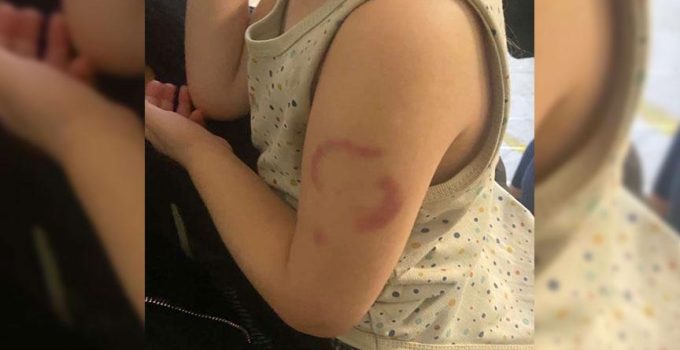 Edirne'de akılalmaz olay! Öğretmen, 3 yaşındaki çocuğu ısırdı: Öperken oldu