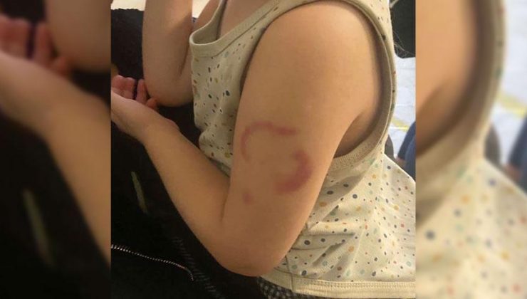 Edirne'de akılalmaz olay! Öğretmen, 3 yaşındaki çocuğu ısırdı: Öperken oldu
