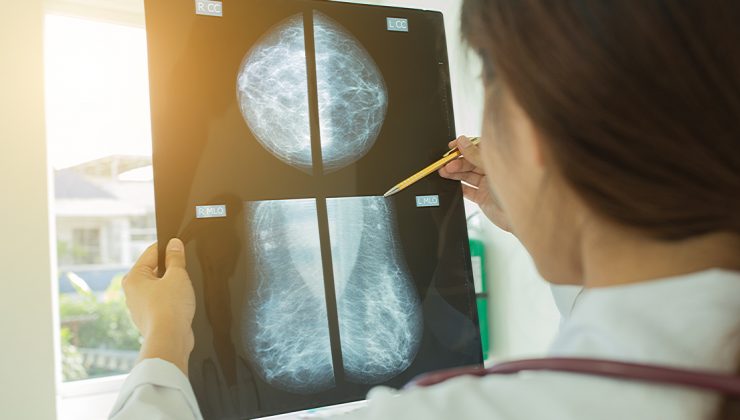 Meme kanseri vakaları artıyor! Türkiye’de her yıl 20 binden fazla kadın risk altında