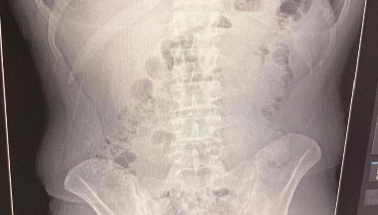 Midelerinden uyuşturucu çıktı: İranlı 3 kişi tutuklandı