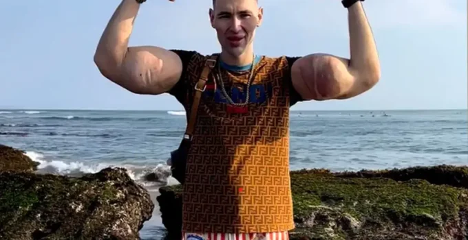 Rus Temel Reis’in kolları tehlikede: Tehlikeli enjeksiyonlar ağır enfeksiyona yol açtı