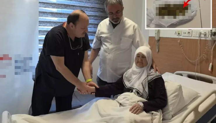 Yaşlı kadının safra kesesinden 213 adet taş çıktı