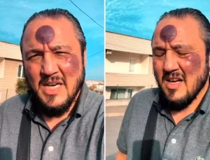 Yüzüne yaptırdığı işlemden sonra bu hale geldi, yine de savundu