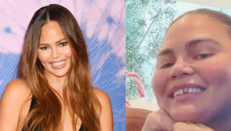 Chrissy Teigen, kırık dişli halini göstermekten çekinmedi