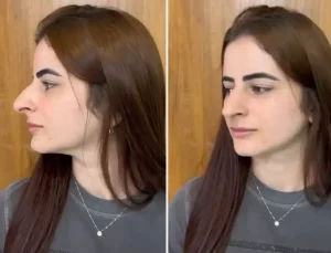 Hevesle burun estetiği oldu ama sonu skandal