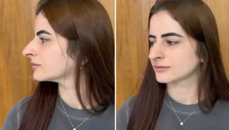 Hevesle burun estetiği oldu ama sonu skandal