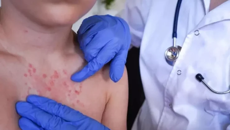 Vakalar pik yaptı! İki haftada ortaya çıkıyor, 3 yıl kadar sürüyor