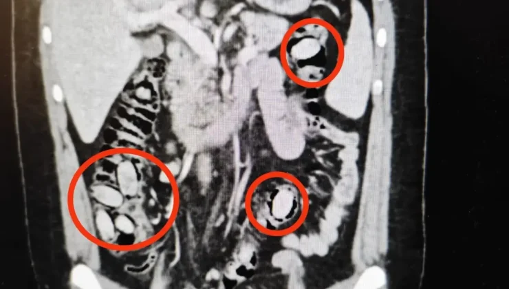 Eskişehir’de polisin durdurduğu şahsın midesinden çıkanlar şoke etti