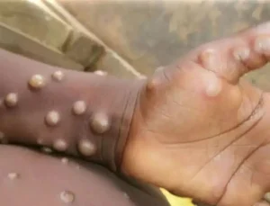 Madagaskar’da ilk defa M çiçeği vakası tespit edildi