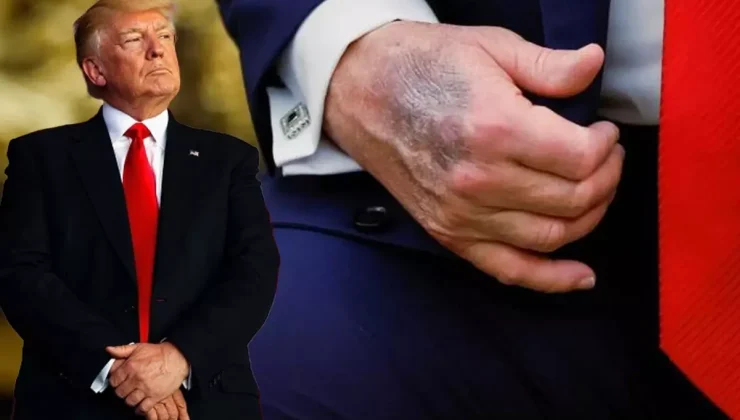 Trump elindeki morluğun nedeni açıkladı