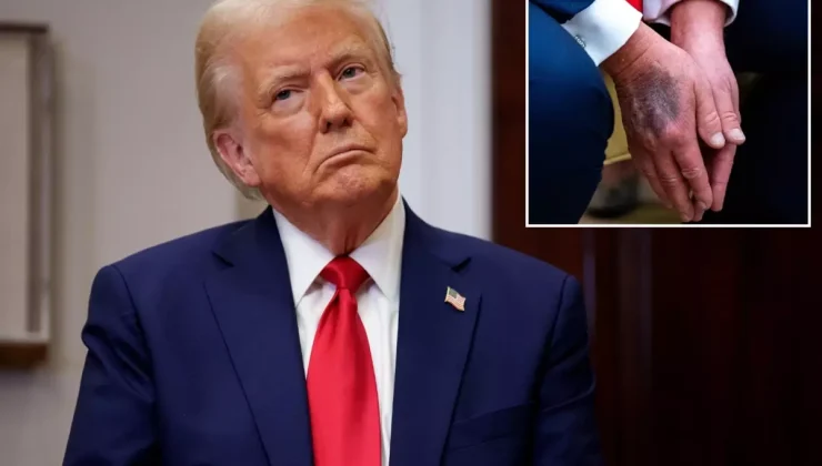 Trump elindeki morlukların nedenini ilk kez açıkladı